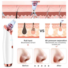 Vacuum Blackhead Remover Face Black Spots Cleaner White Dot Pimple Removal | Blackhead Remover For Nose,facial Pore Acne Grease Cleaner Skin Care
